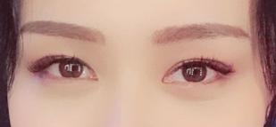 超声波去眼袋