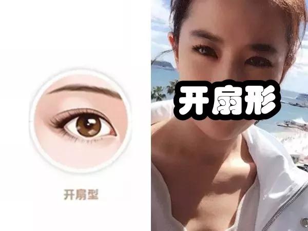 双眼皮手术