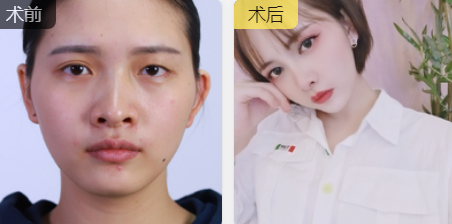 双眼皮手术
