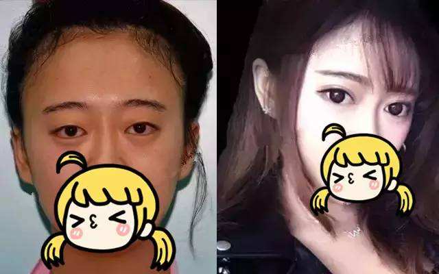 双眼皮手术