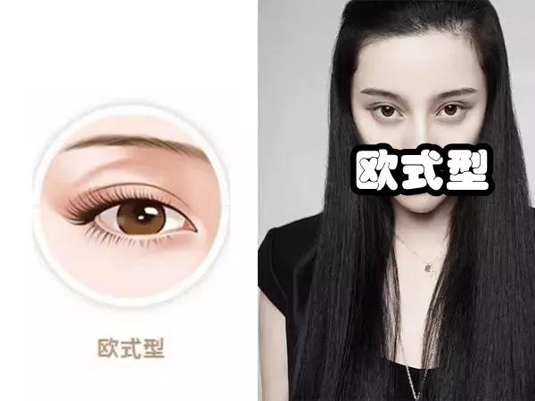双眼皮手术