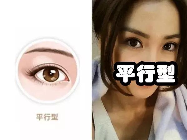 双眼皮手术