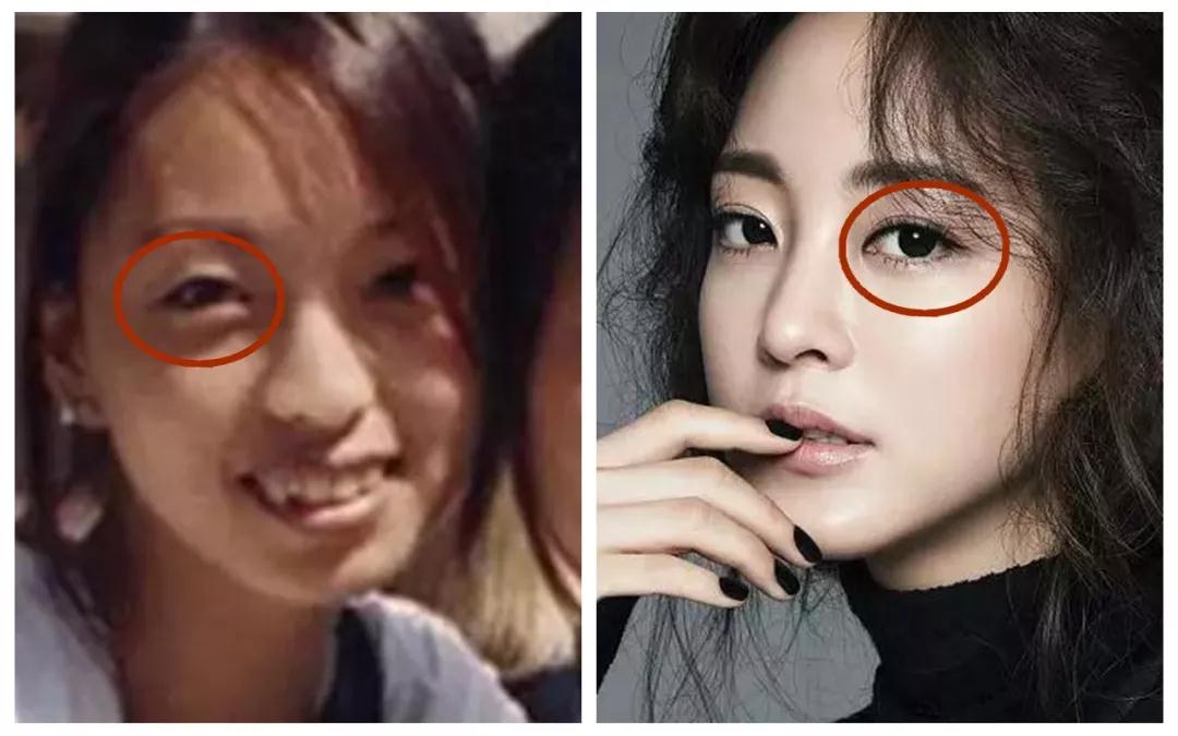 双眼皮手术