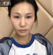 双眼皮手术