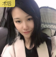 双眼皮手术
