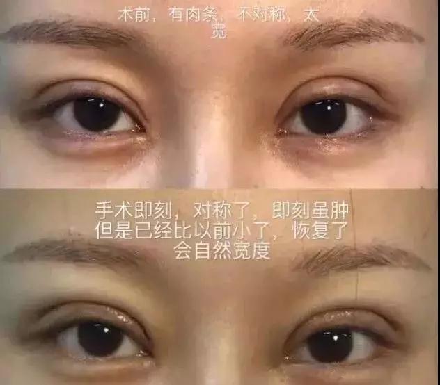 双眼皮手术