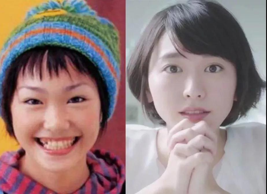 双眼皮手术