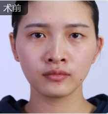 双眼皮手术