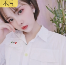 双眼皮手术