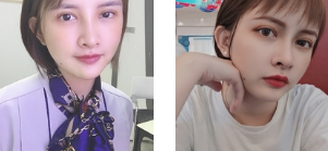 双眼皮手术