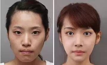 双眼皮手术