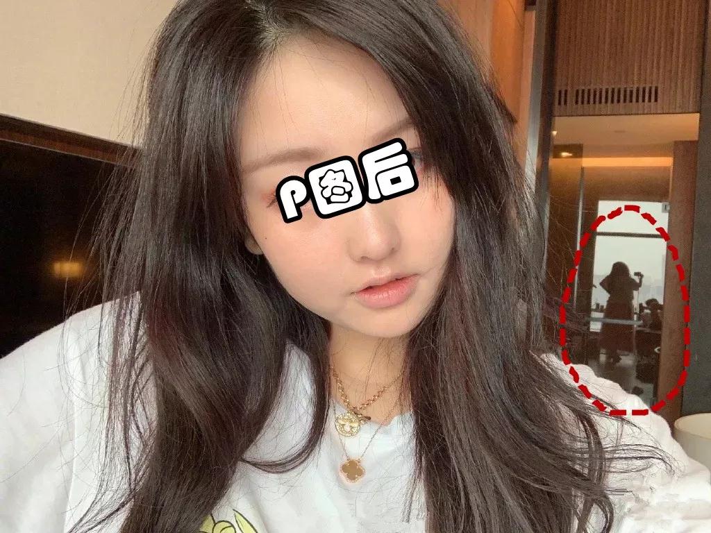 吸脂减肥