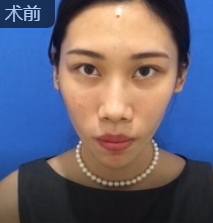 吸脂减肥