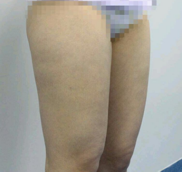 吸脂减肥