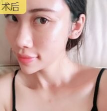 吸脂减肥
