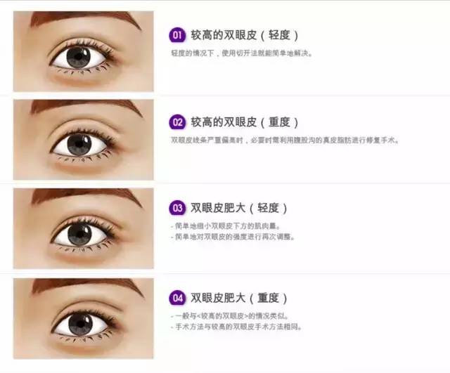 双眼皮手术
