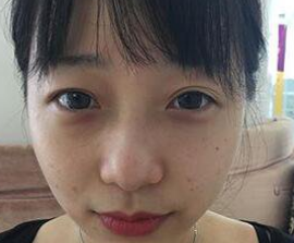 双眼皮手术