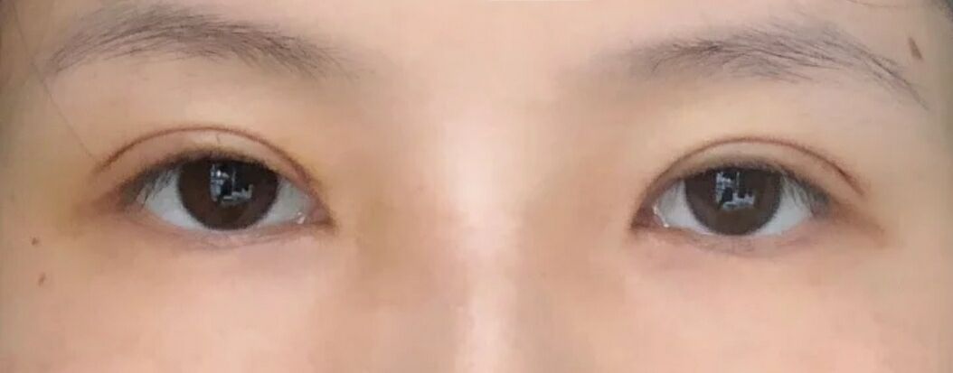 超声波按摩双眼皮