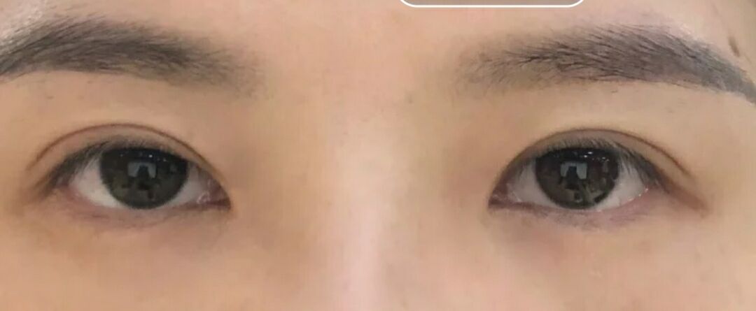 超声波按摩双眼皮