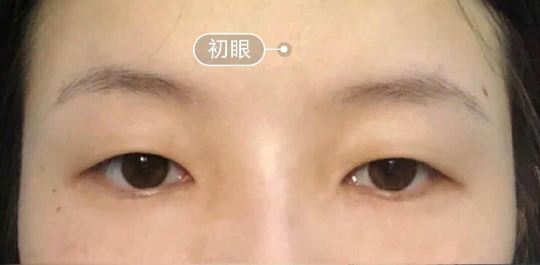 超声波按摩双眼皮