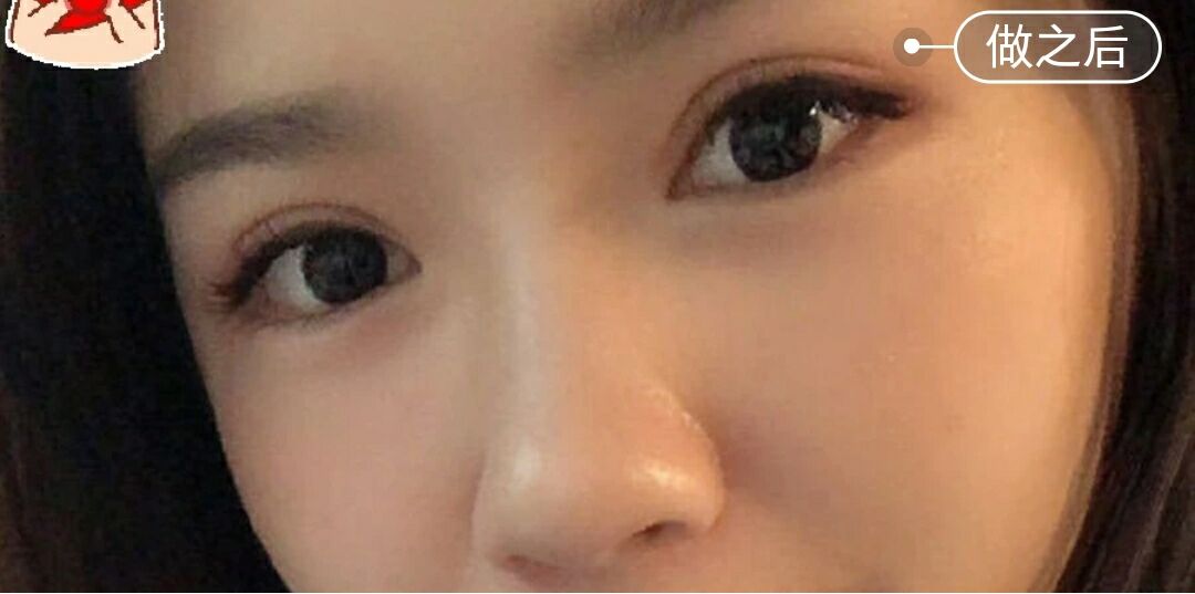 超声波按摩双眼皮