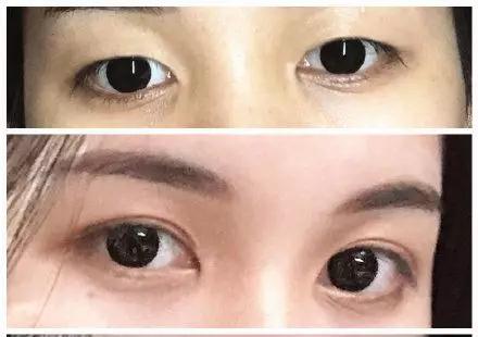 双眼皮手术