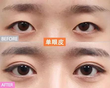 双眼皮手术