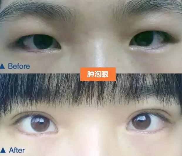 双眼皮手术