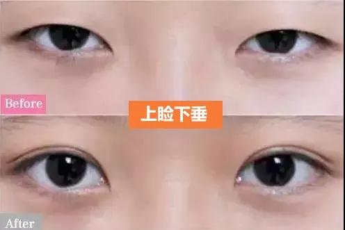 双眼皮手术