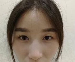 双眼皮手术