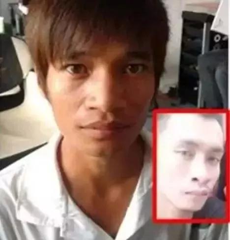 双眼皮手术