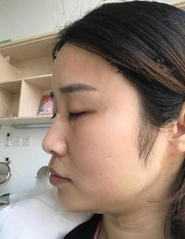 玻尿酸