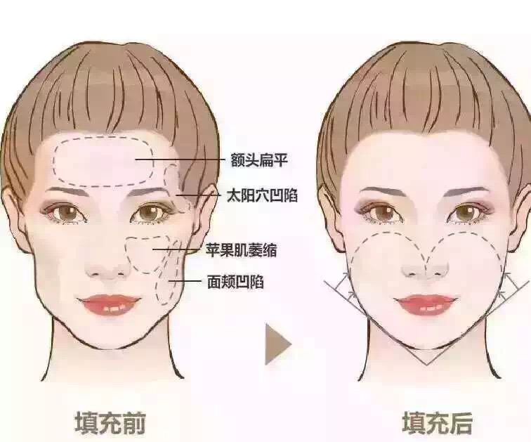自体脂肪面部填充术