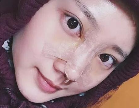 隆鼻手术