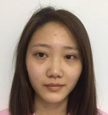 隆鼻手术