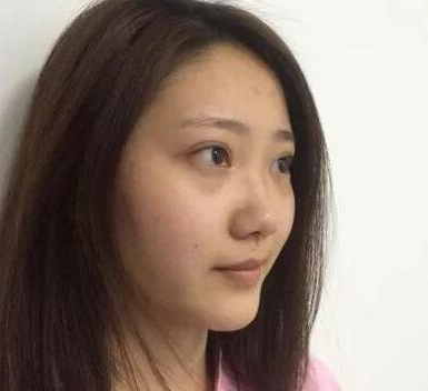 隆鼻手术
