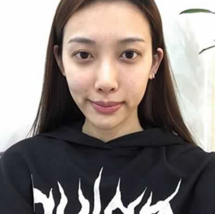 超声波祛眼袋