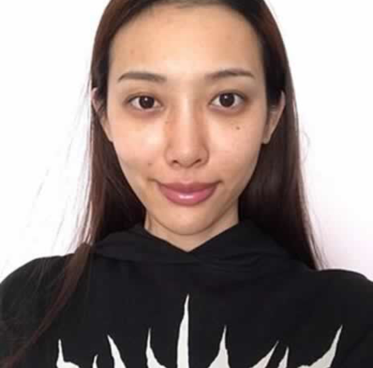 超声波祛眼袋