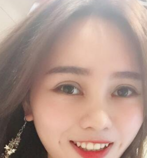 双眼皮手术