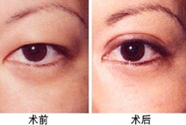 双眼皮手术