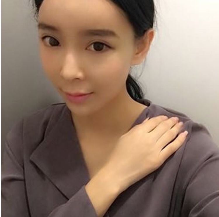 超声波祛眼袋