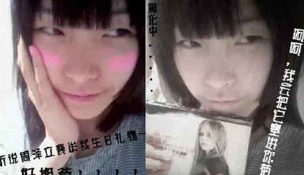双眼皮手术