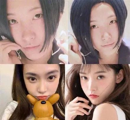 双眼皮手术