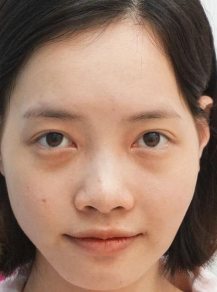 自体脂肪填充术