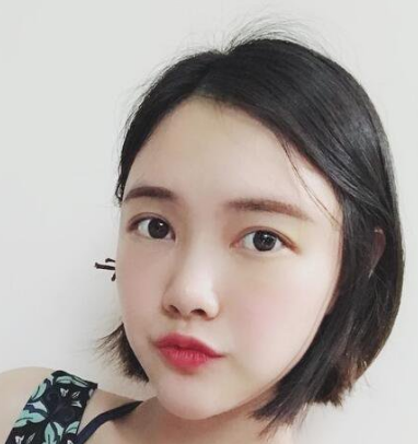 自体脂肪填充术
