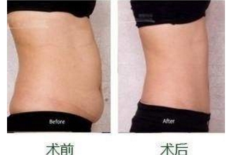 吸脂减肥