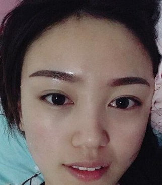 超声波去眼袋