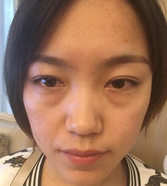 超声波去眼袋