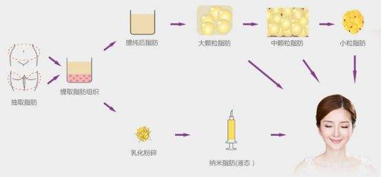 自体脂肪填充术