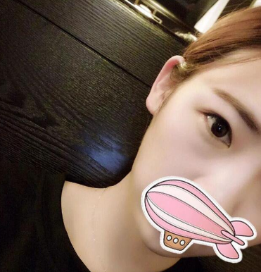 双眼皮手术
